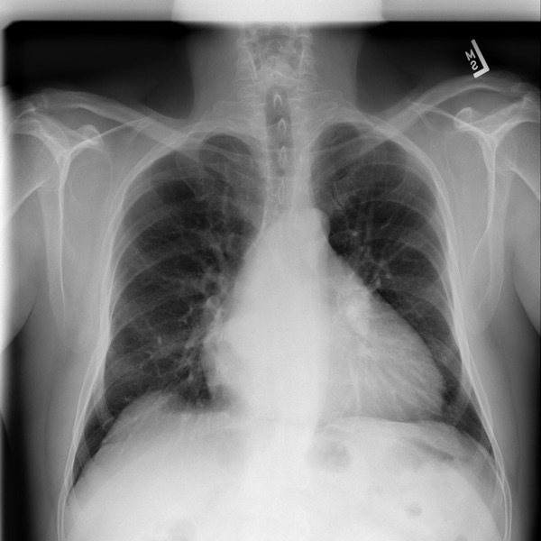 Frontal chest X-ray